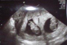 9-weeks-pregnant-with-twins-ultrasound-i11